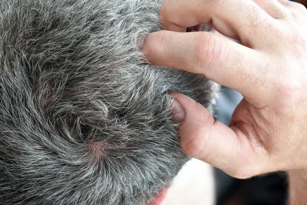 Duele el injerto capilar: la verdad sobre el dolor que casi nadie explica bien