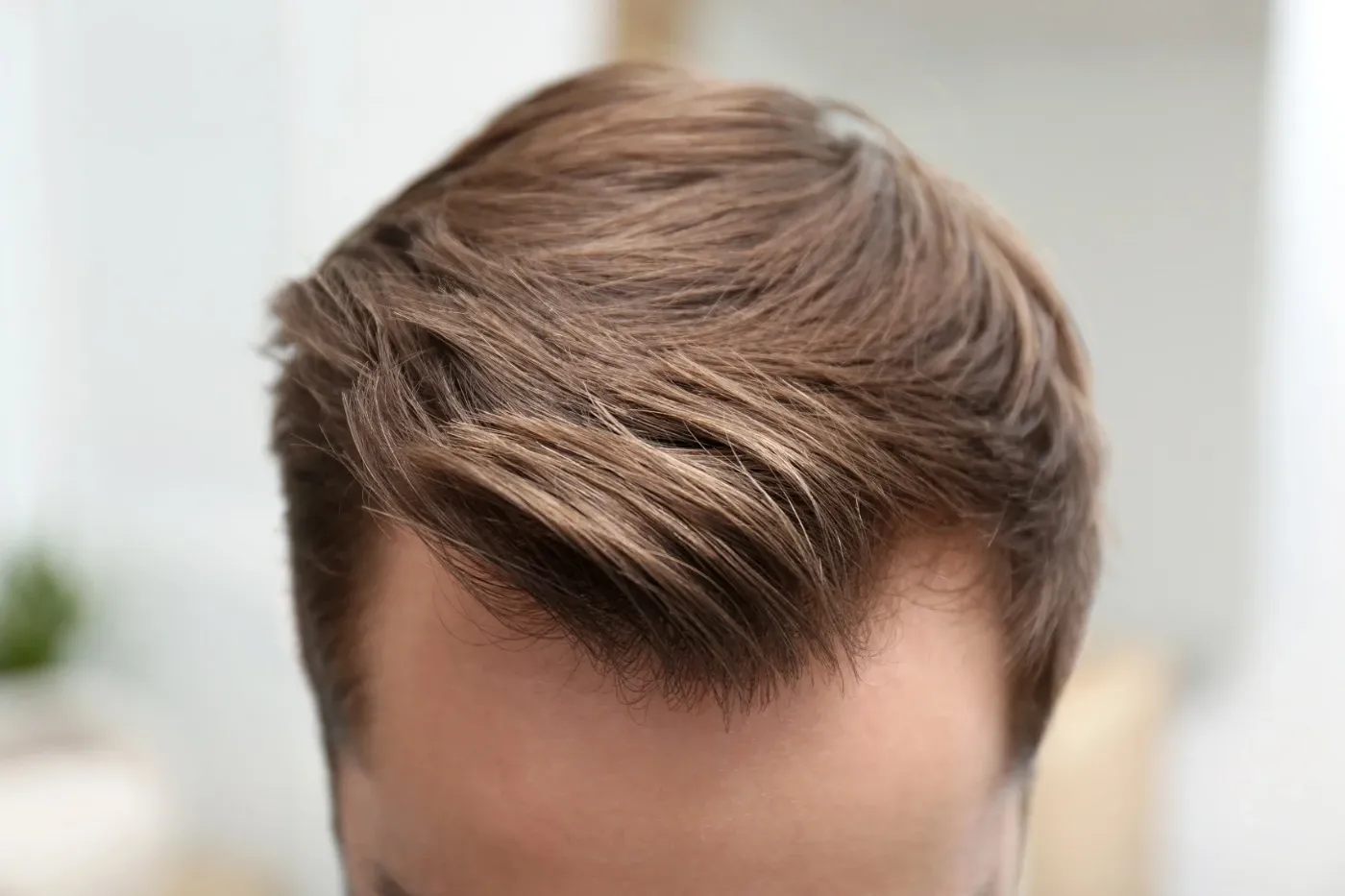 Trasplante de pelo en Málaga con técnica FUE de última generación
