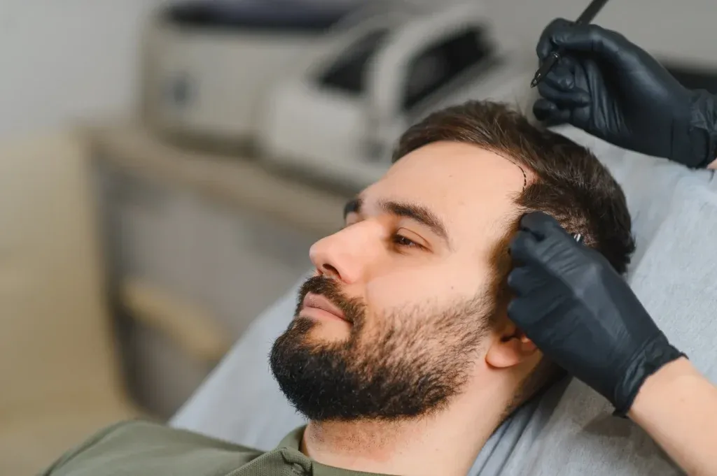 Clínica de implantes capilares en Málaga