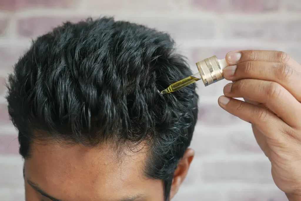 Cómo usar minoxidil después de injerto capilar y cuándo empezar el tratamiento