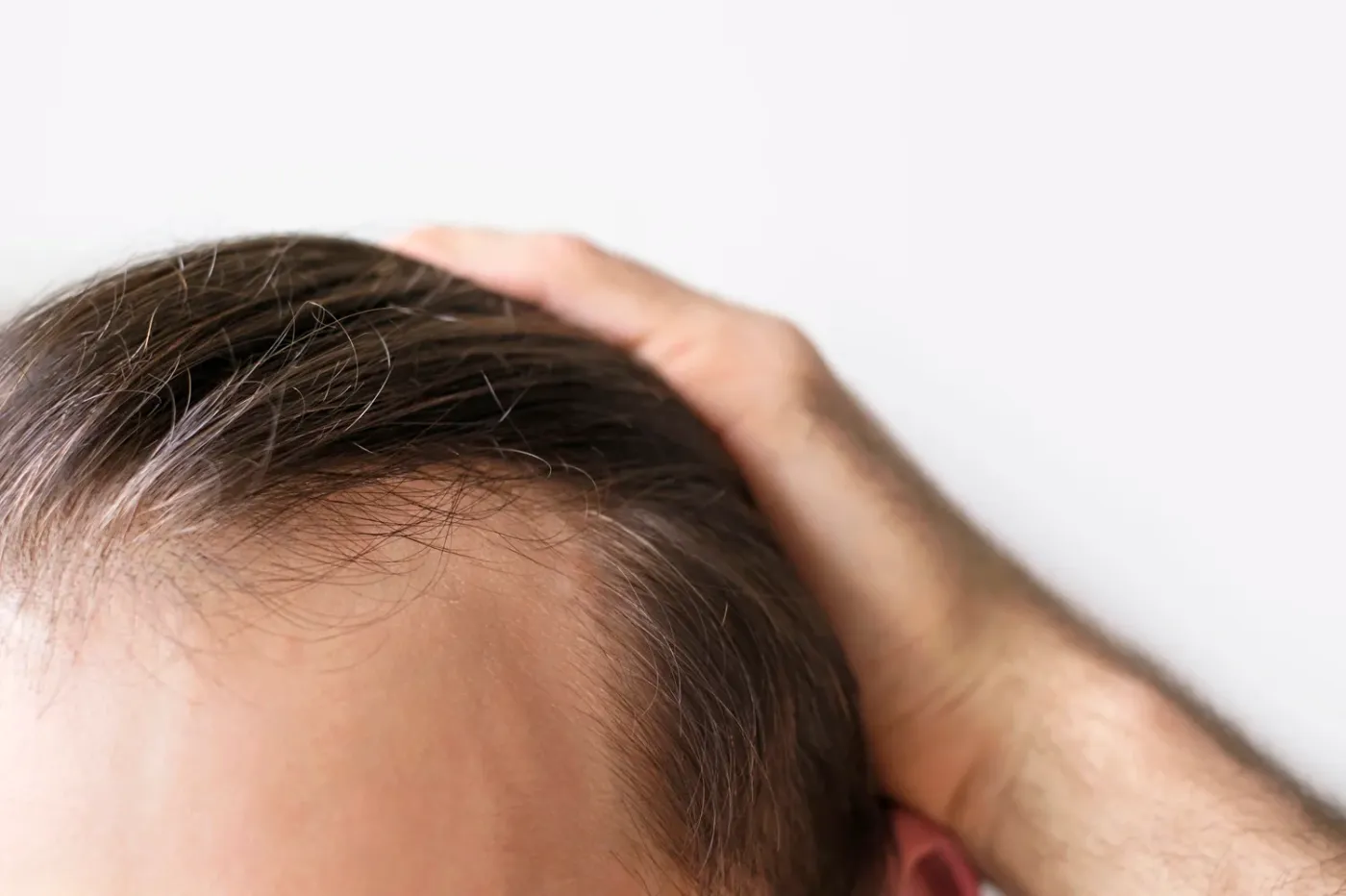 Entradas pronunciadas en hombres: tratamientos para recuperar la línea capilar