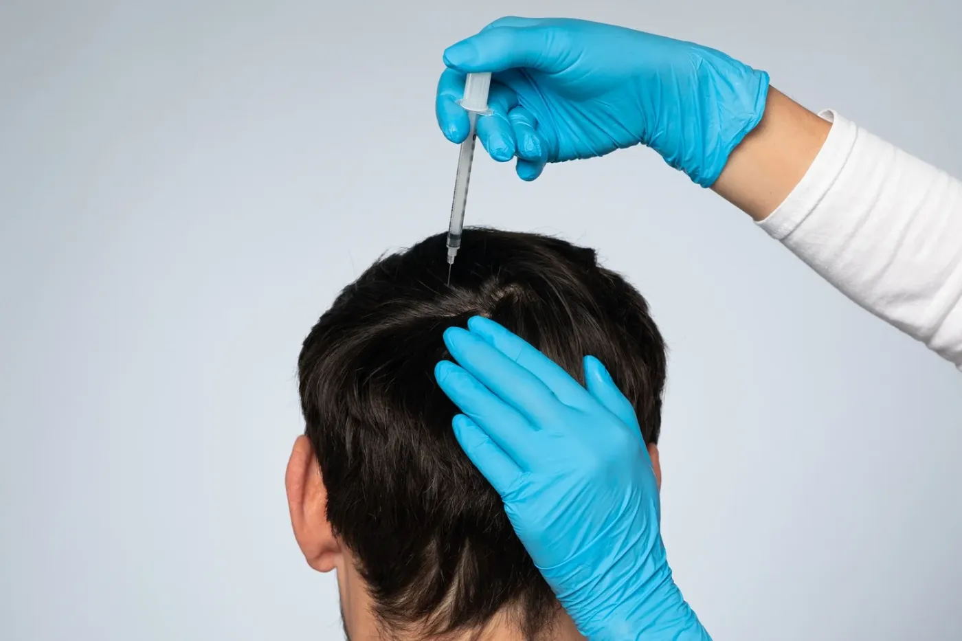 Cómo usar minoxidil después de injerto capilar y cuándo empezar el tratamiento