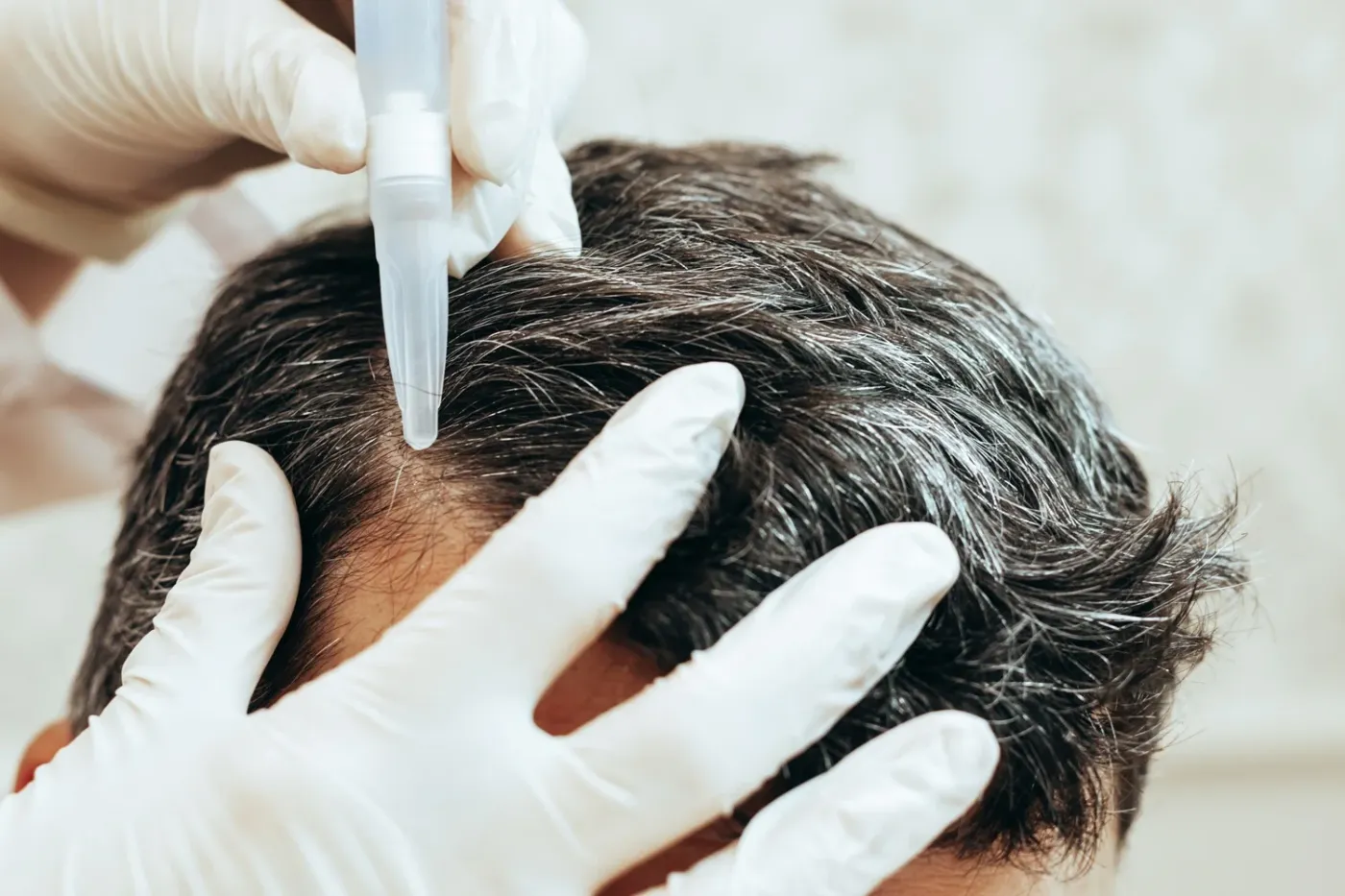 Dutasteride tras un injerto capilar: cómo ayuda a mantener el cabello