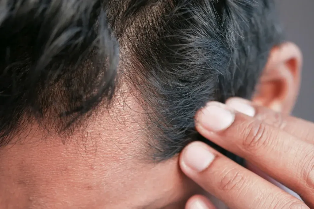 Finasteride e injerto capilar: cuándo se recomienda y qué beneficios aporta