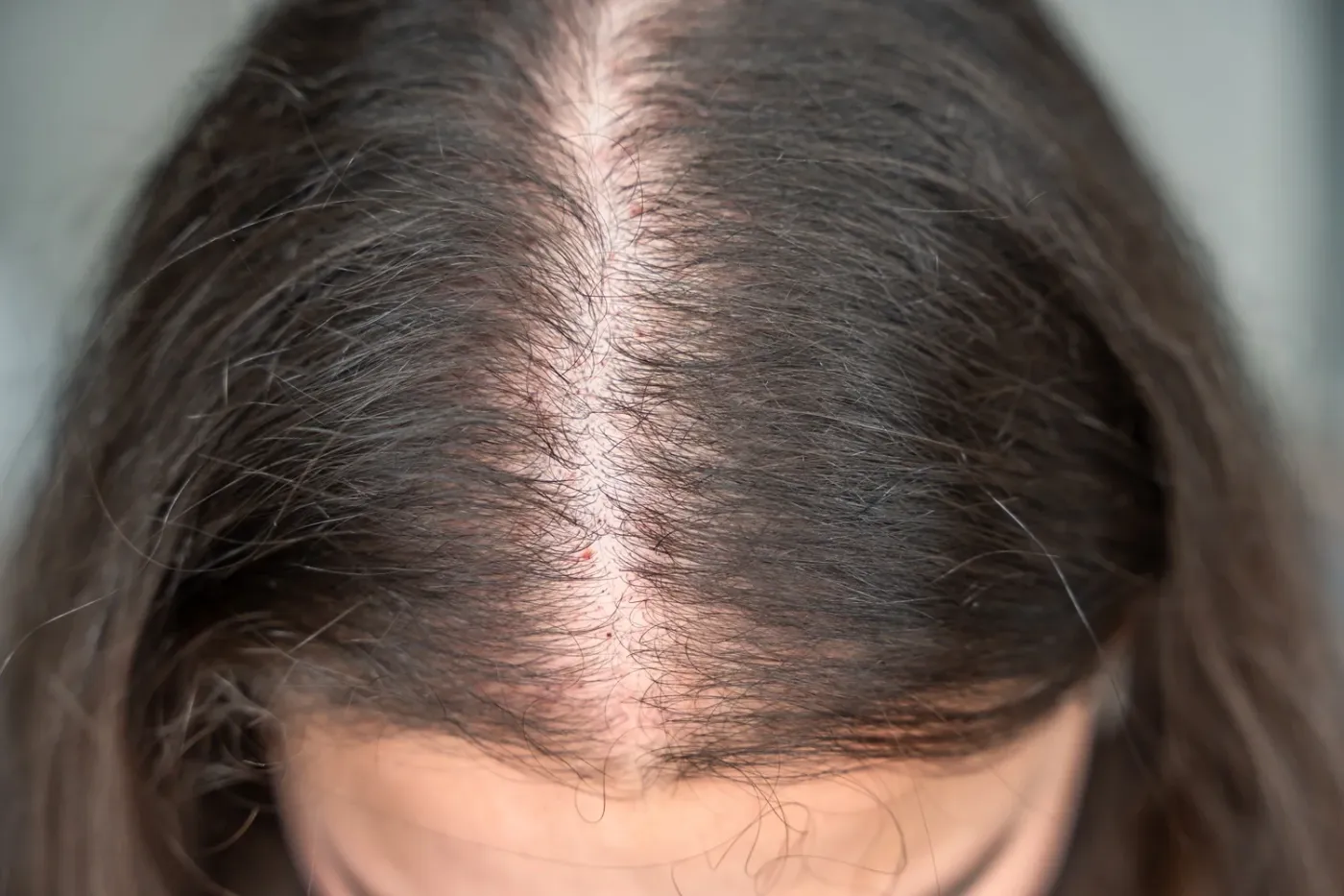 Tratamientos para la alopecia femenina: opciones para fortalecer y recuperar el cabello